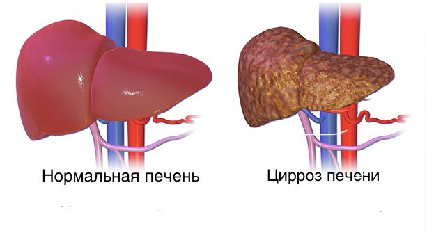 Progressirovanie Zabolevaniya Pecheni